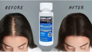 Thuốc mọc tóc minoxidil topical solution USP 5% giá bao nhiêu? Mua ở đâu uy tín