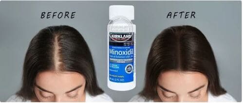 thuoc-moc-toc-minoxidil-topical-solution-usp-5-gia-bao-nhieu-mua-o-dau-uy-tin2